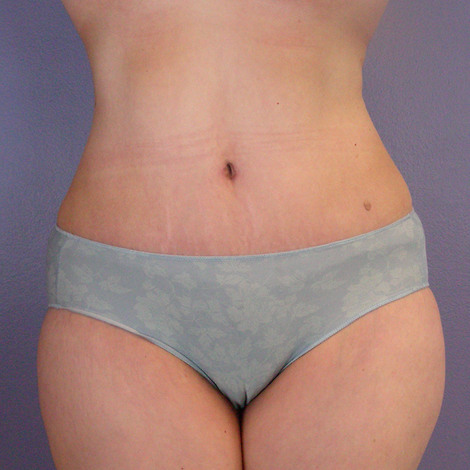 Liposuction before and after photo