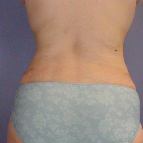 Liposuction before and after photo