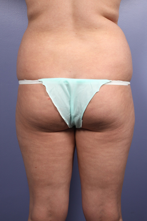 Liposuction before and after photo