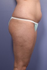 Liposuction Before and after photo