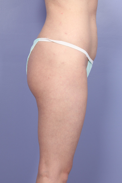 Liposuction before and after photo