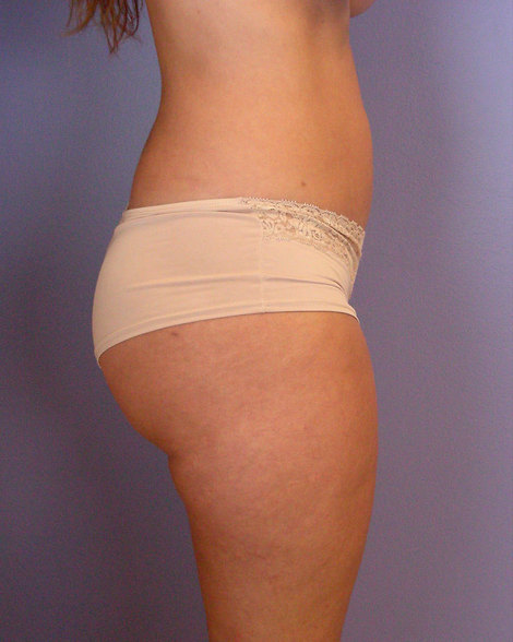 Liposuction before and after photo