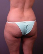 Liposuction Before and after photo