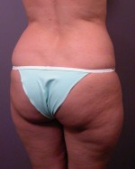 Liposuction Before and after photo