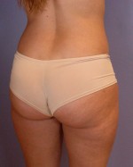 Liposuction Before and after photo