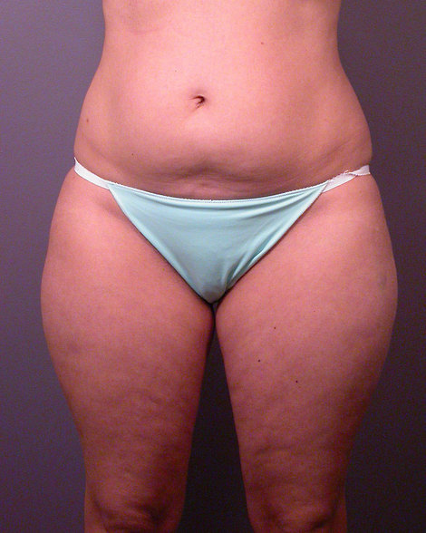 Liposuction before and after photo