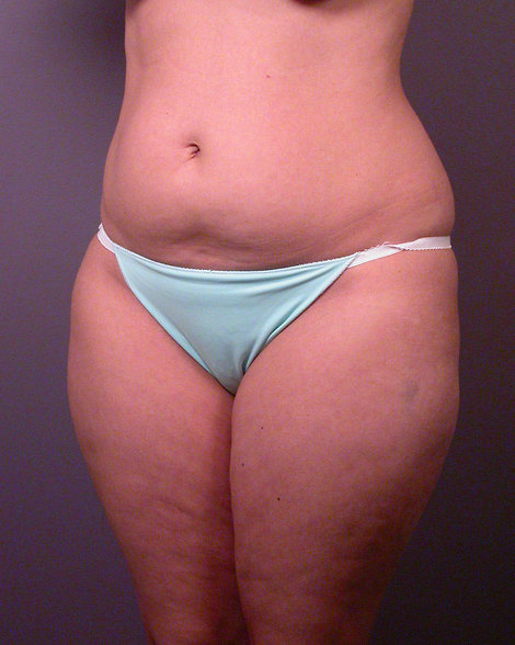 Liposuction before and after photo