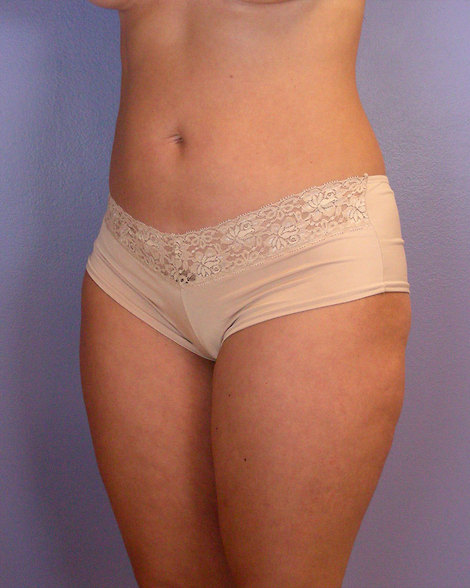 Liposuction before and after photo