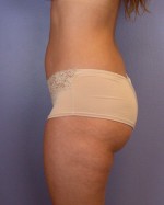 Liposuction Before and after photo