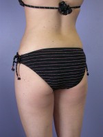 Liposuction Before and after photo