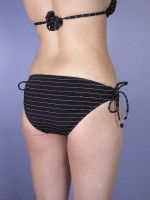 Liposuction Before and after photo