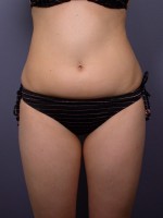 Liposuction