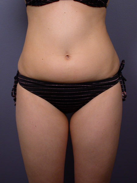 Liposuction before and after photo