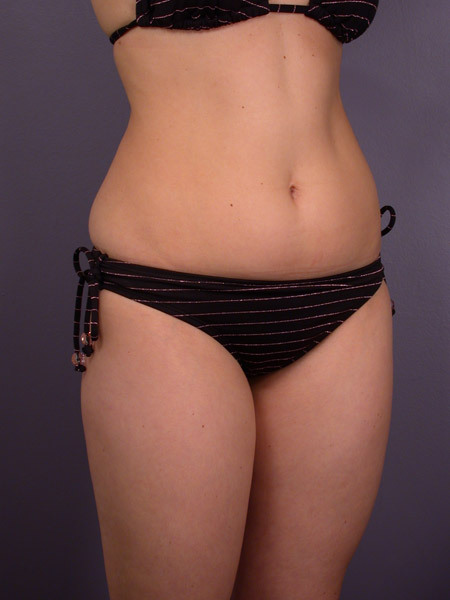 Liposuction before and after photo