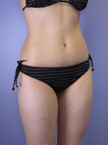 Liposuction before and after photo