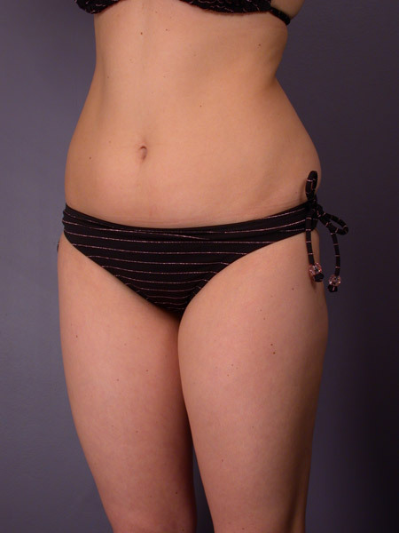 Liposuction before and after photo