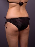 Liposuction Before and after photo