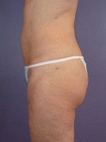 Liposuction Before and after photo