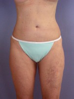 Liposuction