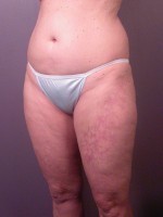 Liposuction Before and after photo