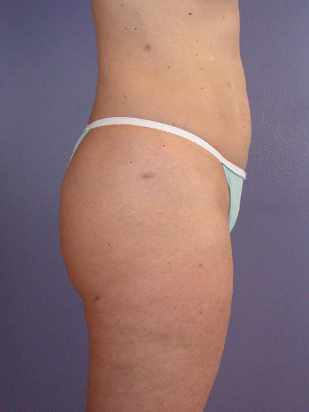 Liposuction before and after photo