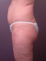 Liposuction Before and after photo