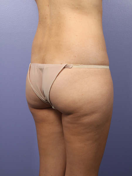 Liposuction before and after photo