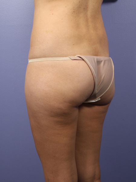 Liposuction before and after photo