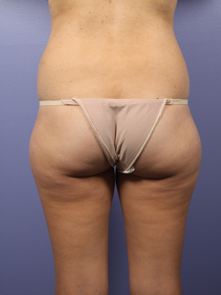 Liposuction before and after photo