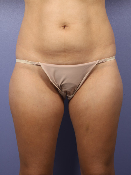 Liposuction before and after photo