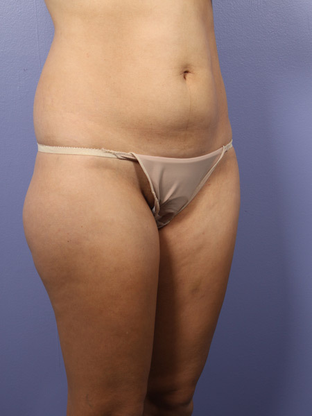 Liposuction before and after photo