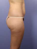 Liposuction Before and after photo