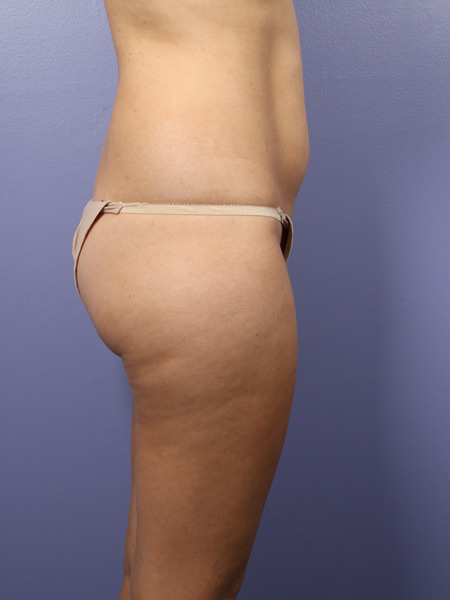 Liposuction before and after photo