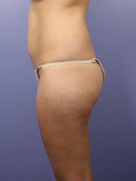 Liposuction before and after photo