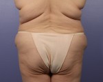 Liposuction Before and after photo