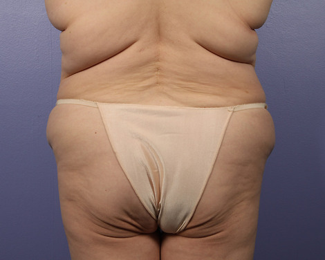 Liposuction before and after photo