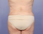 Liposuction Before and after photo