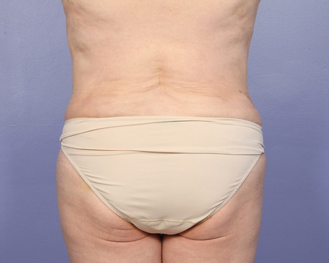 Liposuction before and after photo