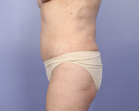 Liposuction before and after photo