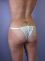 Liposuction Before and after photo