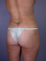 Liposuction Before and after photo