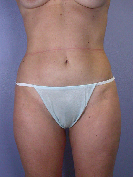 Liposuction before and after photo