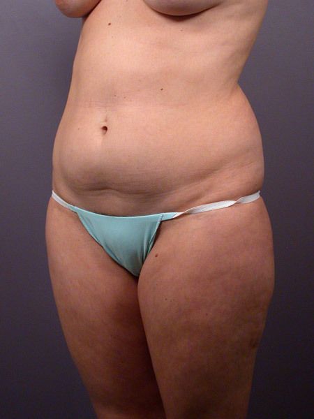 Liposuction before and after photo