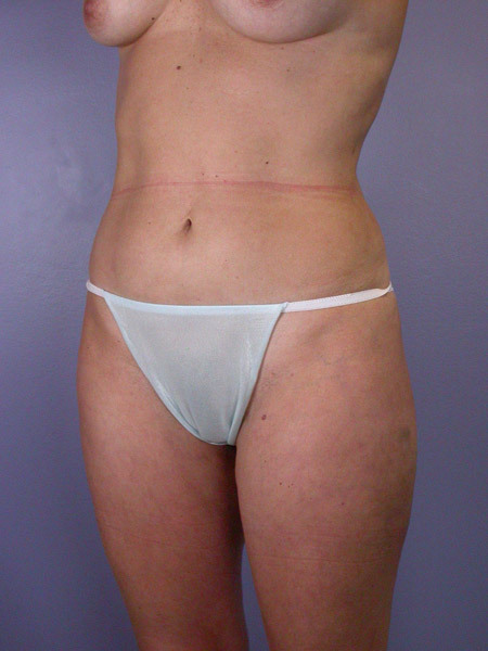 Liposuction before and after photo