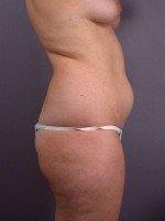 Liposuction Before and after photo