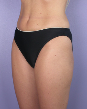 Liposuction before and after photo