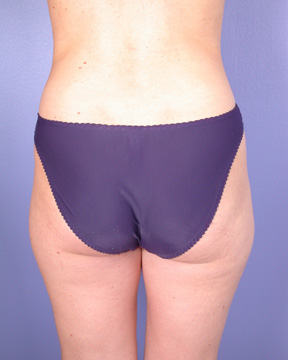 Liposuction before and after photo