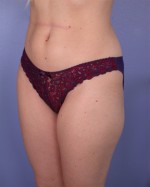 Liposuction Before and after photo