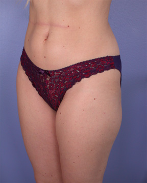 Liposuction before and after photo