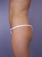 Liposuction Before and after photo